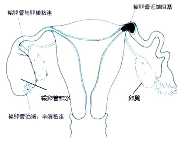做借卵试管婴儿的全部过程是什么？胚胎培养3天和5天的区别