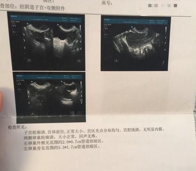 做借卵试管进周是什么意思