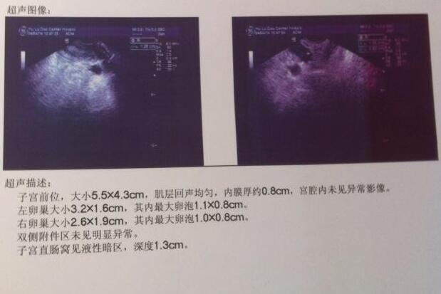 供卵做试管婴儿移植疼吗,需要多长时间